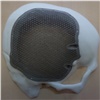 Красноярские врачи впервые исправили дефект черепа с использованием технологий 3D