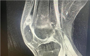 Красноярские врачи помогли пациенту из Монголии с редкой аномалией в коленном суставе