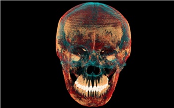 Сибирские ученые нашли следы уникальной операции на черепе скифской женщины