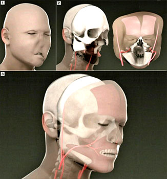 Технология пересадки лица