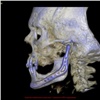 Красноярские хирурги впервые вживили напечатанную на 3D-принтере челюсть