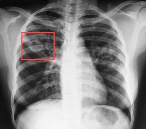 Рентгенограмма больного туберкулезом
